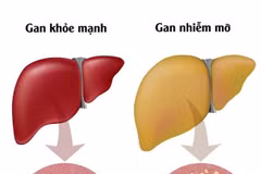 Gan nhiễm mỡ ngày càng phổ biến do lối sống hiện đại