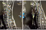 MRI tư thế trung gian và MRI tư thế gập cổ