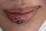 Một thiếu nữ bị biến dạng môi nghiêm trọng do tiêm filler tại spa