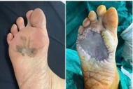 Phát hiện ung thư từ vết đen ở bàn chân suốt 15 năm