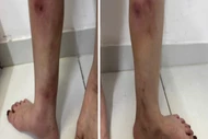 Tiêm filler làm thẳng chân tại nhà gây biến dạng, nguy cơ hoại tử