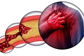 Soi gương thấy 3 dấu hiệu này có thể bạn đã bị mỡ máu cao