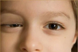 Trẻ sụp mi đi khám, phát hiện mắc hội chứng hiếm gặp ở mắt
