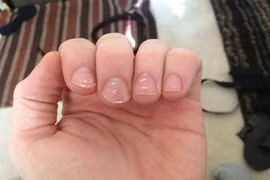 Đừng chủ quan với đốm trắng xuất hiện trên móng tay