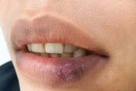  Tưởng khô môi, dị ứng đi khám mắc lupus ban đỏ dạng đĩa