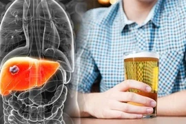 Cảnh báo 4 bệnh âm thầm đe dọa người uống rượu bia