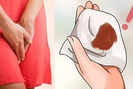 Máu kinh ra nhiều bất thường - dấu hiệu u xơ tử cung