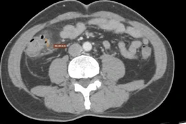 Đau bụng âm ỉ quanh rốn, đi khám mắc viêm túi thừa đại tràng