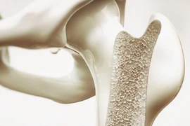 Xương dễ loãng nếu ăn nhiều 5 loại thực phẩm này