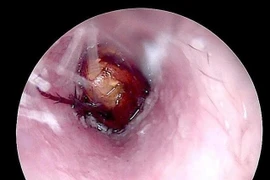Gắp thành công côn trùng sống trong ống tai bệnh nhân ở Quảng Trị