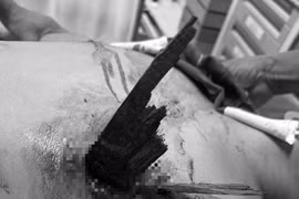 Cứu sống nam thanh niên bị gỗ đâm thấu ngực ở Quảng Bình