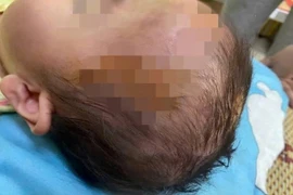 Bé gái 19 tháng tuổi bị chó cắn tổn thương nặng vùng mặt