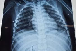 Bé trai bị đa chấn thương nghiêm trọng do nghịch súng hơi