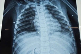 Bé trai bị đa chấn thương nghiêm trọng do nghịch súng hơi