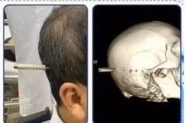 Cứu sống người đàn ông bị phi tiêu cắm trúng đầu