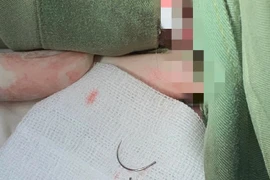 Gắp thành công dị vật nằm trong tầng sinh môn người phụ nữ suốt 11 năm