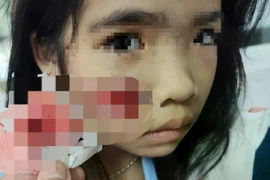 Bé gái ở Quảng Trị bị khỉ hoang tấn công gây thương tích