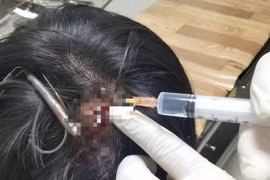 Nam sinh ở Quảng Trị bị móc câu cắm sâu vào đỉnh đầu