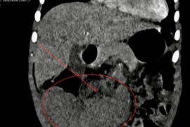 Phẫu thuật nội soi cắt lách xoắn cho bệnh nhi ở Quảng Trị