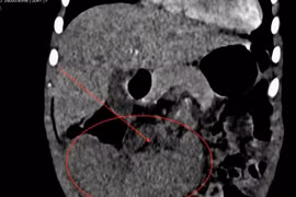 Phẫu thuật nội soi cắt lách xoắn cho bệnh nhi ở Quảng Trị