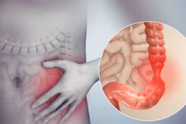 Căn bệnh đường ruột phổ biến, nhiều người không để ý