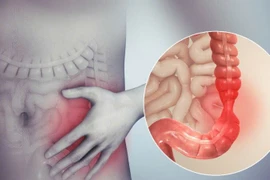 Căn bệnh đường ruột phổ biến, nhiều người không để ý