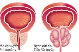 Tuyến tiền liệt phì đại, hiểu đúng để phòng ngừa, điều trị kịp thời