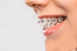 Sai lầm cần tránh khi niềng răng