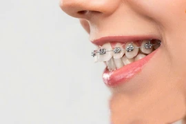 Sai lầm cần tránh khi niềng răng