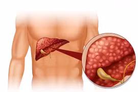 Chức năng gan bị ảnh hưởng bởi rối loạn chuyển hóa