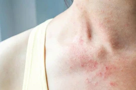 Mẹo phòng tránh dị ứng hiệu quả khi thời tiết thay đổi
