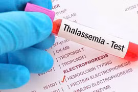 Hiểu đúng về bệnh tan máu bẩm sinh