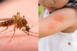 Cách xử lý côn trùng đốt