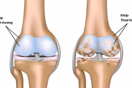 Bí quyết giảm đau xương khớp hiệu quả