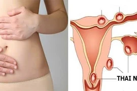 Ngăn chặn chửa ngoài tử cung từ sớm với 7 thói quen đơn giản