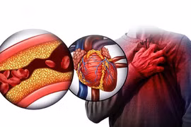 Mỡ trong máu, nguy cơ không thể xem thường