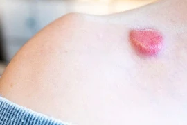 Ngăn chặn ung thư da, lão hoá sớm
