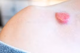 Ngăn chặn ung thư da, lão hoá sớm
