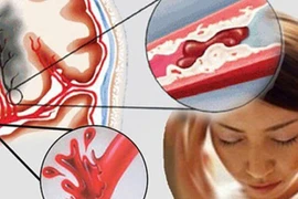 Nguy cơ đột quỵ ở người dưới 40 tuổi