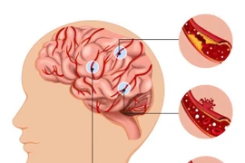 Hướng dẫn xử lý đúng khi người thân tai biến mạch máu não