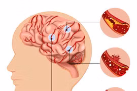 Hướng dẫn xử lý đúng khi người thân tai biến mạch máu não