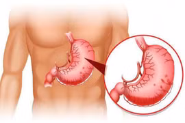 Bảo vệ dạ dày từ những thói quen nhỏ tránh xuất huyết tiêu hóa