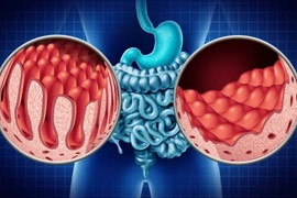 Hiểu đúng, phòng tránh hội chứng ruột rò rỉ