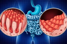 Hiểu đúng, phòng tránh hội chứng ruột rò rỉ