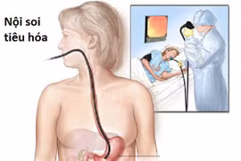 Dấu hiệu cần nội soi tiêu hóa để phát hiện sớm bệnh lý
