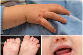 Đừng chủ quan bệnh tay chân miệng khi trời mưa ẩm ướt