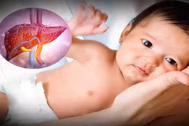 Phòng ngừa, phát hiện sớm viêm gan lạ ở trẻ nhỏ