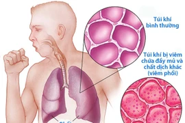 Cách phòng ngừa biến chứng nguy hiểm của viêm phổi