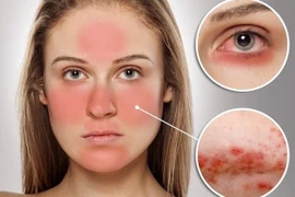 Nhận biết dấu hiệu lupus, phòng ngừa tổn thương nội tạng