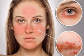 Nhận biết dấu hiệu lupus, phòng ngừa tổn thương nội tạng